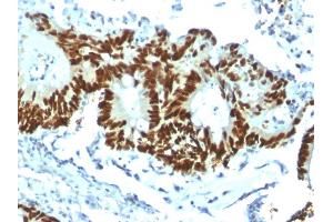 Formalin-fixed, paraffin-embedded human Colon Carcinoma stained with p53 Recombinant Rabbit Monoclonal Antibody (TP53/1799R). (Rekombinanter p53 Antikörper)