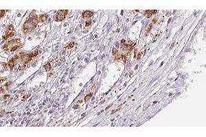 ABIN6272308 at 1/100 staining Human liver cancer tissue by IHC-P. (FFAR3 Antikörper  (C-Term))