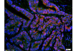 Formalin-fixed and paraffin-embedded human colon carcinoma labeled with Anti-ompF(putative outer membrane porin F protein) Polyclonal Antibody, Unconjugated (ABIN677363) 1:200, overnight at 4°C, The secondary antibody was Goat Anti-Rabbit IgG, Cy3 conjugated used at 1:200 dilution for 40 minutes at 37°C. (Ompf (AA 171-213) Antikörper)