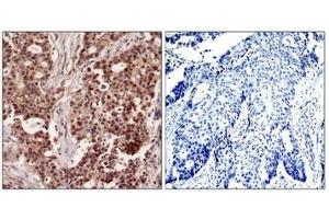 Immunohistochemical analysis of paraffin-embedded human breast carcinoma tissue using NFkB-p105(Phospho-Ser927) Antibody(left) or the same antibody preincubated with blocking peptide(right). (NFKB1 Antikörper  (pSer927))