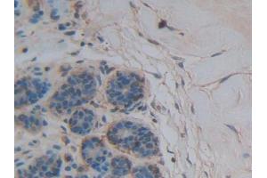 DAB staining on IHC-P; Samples: Human Breast cancer Tissue (Thrombospondin 1 Antikörper  (AA 24-221))