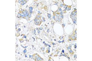 Immunohistochemistry of paraffin-embedded Human breast cancer using TIMP2 antibody (ABIN7268483) at dilution of 1:150 (40x lens). (TIMP2 Antikörper  (AA 100-200))