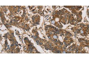 Immunohistochemistry of paraffin-embedded Human colon cancer tissue using UBE2S Polyclonal Antibody at dilution 1:40 (UBE2S Antikörper)