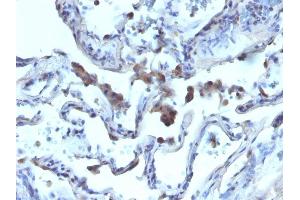 Formalin-fixed, paraffin-embedded human Lung Carcinoma stained with AMACR / p504S Rabbit Polyclonal Antibody. (AMACR Antikörper)