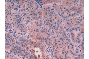 DAB staining on IHC-P; Samples: Human Liver cancer Tissue (KRT8 Antikörper  (AA 92-393))