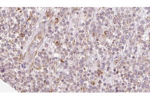ABIN6273209 at 1/100 staining Human lymph cancer tissue by IHC-P. (SH3KBP1 Antikörper  (N-Term))