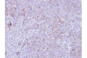 IHC-P Image Immunohistochemical analysis of paraffin-embedded DLD-1 xenograft , using SLC26A8, antibody at 1:500 dilution. (SLC26A8 Antikörper  (C-Term))