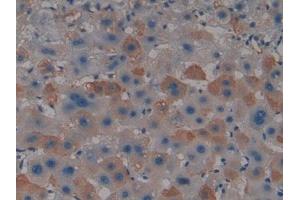 IHC-P analysis of Human Liver cancer Tissue, with DAB staining. (PAD4 Antikörper  (AA 1-300))