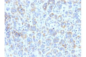 Formalin-fixed, paraffin-embedded human Melanoma stained with TYRP1 Mouse Monoclonal Antibody (TYRP1/807) (Tyrosinase-Related Protein 1 Antikörper)