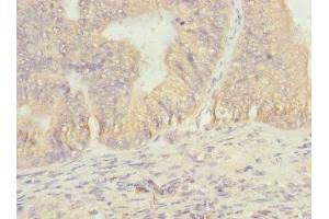 Immunohistochemistry of paraffin-embedded human prostate cancer using ABIN7172901 at dilution of 1:100 (EIF2B1 Antikörper  (AA 1-305))