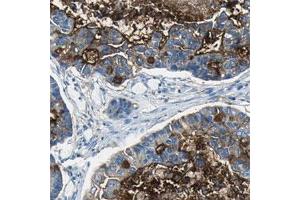 Immunohistochemical staining of human lung cancer, adenocarcinoma shows moderate cytoplasmic positivity in tumor cells. (MUC4 Antikörper)