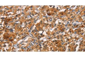 Immunohistochemistry of paraffin-embedded Human thyroid cancer tissue using CDC25B Polyclonal Antibody at dilution 1:45 (CDC25B Antikörper)