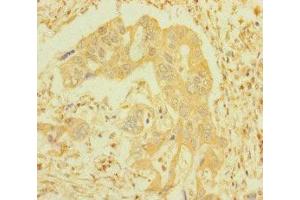 Immunohistochemistry of paraffin-embedded human pancreatic cancer using ABIN7156691 at dilution of 1:100 (IFITM5 Antikörper  (AA 1-36))