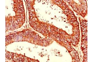Immunohistochemistry of paraffin-embedded human endometrial cancer using ABIN7174480 at dilution of 1:100 (CDC34 Antikörper  (AA 1-236))