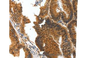 Immunohistochemistry of Human ovarian cancer using BIRC6 Polyclonal Antibody at dilution of 1:30