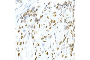 Immunohistochemistry of paraffin-embedded human esophageal cancer using Phospho-Histone H3. (Histone H3.3 Antikörper  (pSer31))