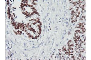 Immunohistochemical staining of paraffin-embedded Adenocarcinoma of Human ovary tissue using anti-TP53 mouse monoclonal antibody. (p53 Antikörper)