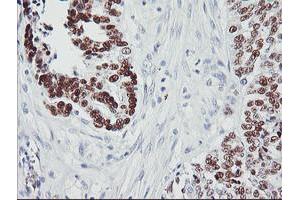 Immunohistochemical staining of paraffin-embedded Adenocarcinoma of Human ovary tissue using anti-TP53 mouse monoclonal antibody. (p53 Antikörper)