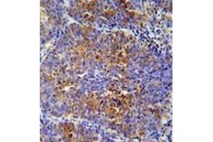 Immunohistochemistry analysis in formalin fixed and paraffin embedded human lung carcinoma reacted with MCAF2 Antibody (Center) Cat. (ATF7IP2 Antikörper  (Middle Region))