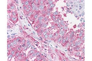 Anti-NEK6 antibody IHC of human Lung, Non-Small Cell Carcinoma. (NEK6 Antikörper  (N-Term))