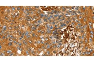 Immunohistochemistry of paraffin-embedded Human esophagus cancer tissue using TAGLN Polyclonal Antibody at dilution 1:30 (Transgelin Antikörper)