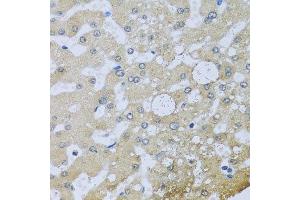 Immunohistochemistry of paraffin-embedded human liver injury using UQCR10 antibody at dilution of 1:100 (x40 lens). (UQCR10 Antikörper)