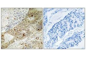 Immunohistochemistry analysis of paraffin-embedded human colon carcinoma tissue, using ATRIP (Phospho-Ser224) antibody. (ATRIP Antikörper  (pSer224))