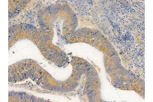 ABIN6263949 and ABIN6272737 at 1/100 staining human colon carcinoma by IHC-P.