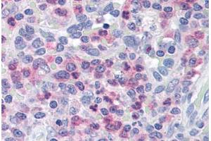 Human Spleen (formalin-fixed, paraffin-embedded) stained with UNC13D antibody ABIN290188 at 2. (UNC13D Antikörper  (AA 1079-1090))