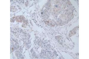 IHC-P analysis of Human Prostate Gland Cancer Tissue, with DAB staining. (IL-19 Antikörper  (AA 25-177))