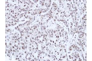 IHC-P Image Immunohistochemical analysis of paraffin-embedded A549 Xenograft, using HNF-1 alpha, antibody at 1:100 dilution. (HNF1A Antikörper)