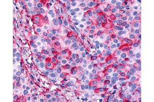 Anti-CELSR1 antibody IHC of human Breast, Carcinoma. (CELSR1 Antikörper  (N-Term))