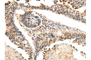 The image on the left is immunohistochemistry of paraffin-embedded Human colon cancer tissue using ABIN7130100(LRP12 Antibody) at dilution 1/25, on the right is treated with fusion protein. (LRP12 Antikörper)