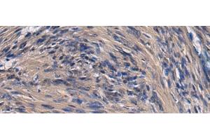 Immunohistochemistry of paraffin-embedded Human brain tissue using ICA1 Polyclonal Antibody at dilution of 1:70(x200) (ICA1 Antikörper)