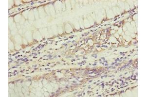 Immunohistochemistry of paraffin-embedded human colon cancer using ABIN7159945 at dilution of 1:100 (KIAA0391 Antikörper  (Catalytic Subunit))