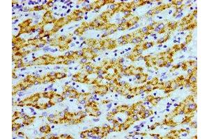 Immunohistochemistry of paraffin-embedded human liver cancer using ABIN7168945 at dilution of 1:100 (AGXT Antikörper  (AA 112-294))