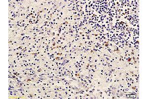 Formalin-fixed and paraffin embedded human cervical carcinoma labeled with Anti-ErbB-3/HER3 Polyclonal Antibody, Unconjugated (ABIN686767) followed by conjugation to the secondary antibody and DAB staining (ERBB3 Antikörper  (AA 661-760))