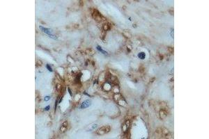 Immunohistochemical analysis of 4EBP1 staining in human prostate cancer formalin fixed paraffin embedded tissue section. (eIF4EBP1 Antikörper  (N-Term))