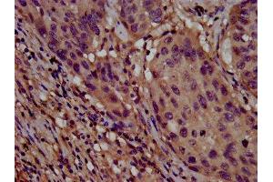 IHC image of ABIN7147931 diluted at 1:800 and staining in paraffin-embedded human lung cancer performed on a Leica BondTM system. (CLPTM1L Antikörper  (AA 32-172))