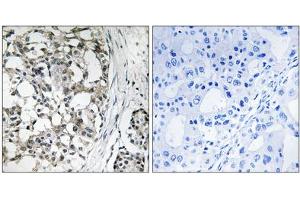 Immunohistochemistry analysis of paraffin-embedded human breast carcinoma tissue using PEX14 antibody. (PEX14 Antikörper  (Internal Region))