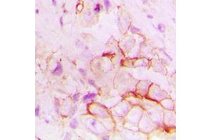 Immunohistochemical analysis of CD143 staining in human breast cancer formalin fixed paraffin embedded tissue section. (Angiotensin I Converting Enzyme 1 Antikörper  (Center))