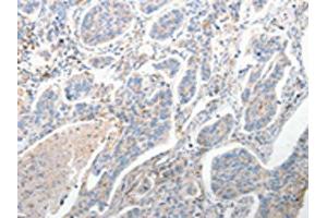 The image on the left is immunohistochemistry of paraffin-embedded Human lung cancer tissue using ABIN7190682(FOXD1 Antibody) at dilution 1/25, on the right is treated with synthetic peptide. (FOXD1 Antikörper)
