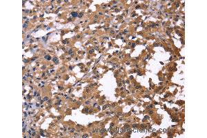 Immunohistochemistry of Human thyroid cancer using IL1A Polyclonal Antibody at dilution of 1:60 (IL1A Antikörper)