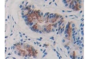 Detection of FBLN4 in Human Stomach cancer Tissue using Polyclonal Antibody to Fibulin 4 (FBLN4) (FBLN4 Antikörper  (AA 26-443))