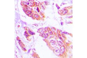 Immunohistochemical analysis of NGEP staining in human lung cancer formalin fixed paraffin embedded tissue section. (Anoctamin 7 Antikörper  (C-Term))