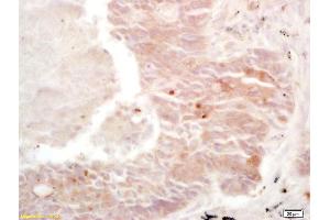 Formalin-fixed and paraffin embedded human lung carcinoma labeled with Rabbit Anti Cullin/C10orf46 Polyclonal Antibody, Unconjugated (ABIN670896) at 1:200 followed by conjugation to the secondary antibody and DAB staining (CACUL1 Antikörper  (AA 181-248))