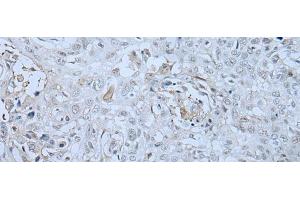 Immunohistochemistry of paraffin-embedded Human lung cancer tissue using HUWE1 Polyclonal Antibody at dilution of 1:30(x200) (HUWE1 Antikörper)