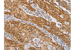 The image on the left is immunohistochemistry of paraffin-embedded Human gastic cancer tissue using ABIN7190211(CENPE Antibody) at dilution 1/50, on the right is treated with synthetic peptide. (CENPE Antikörper)