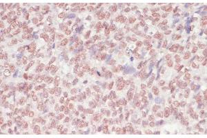 Immunohistochemistry of paraffin-embedded Human oophoroma using SNRNP70 Polyclonal Antibody at dilution of 1:100 (40x lens). (SNRNP70 Antikörper)