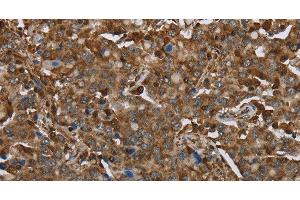 Immunohistochemistry of paraffin-embedded Human liver cancer using ARHGDIA Polyclonal Antibody at dilution of 1:30 (ARHGDIA Antikörper)